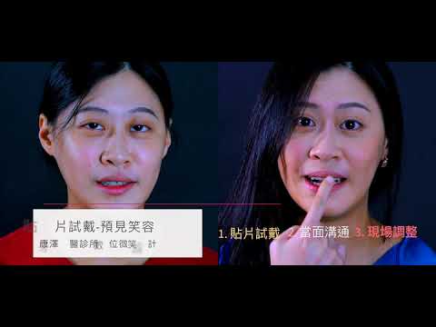 DSD數位設計全瓷貼片｜術後分享 前牙美學陶瓷美白貼片