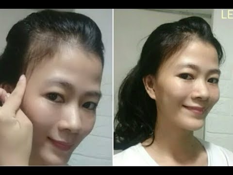 Video Cắt tóc khắc phục tóc hói 2 bên thái dương ,cut hair - youtube