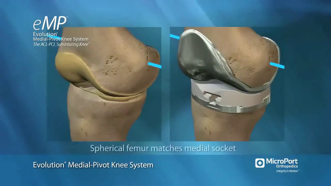 eMP® Medial Pivot Knee Introduction Video UK