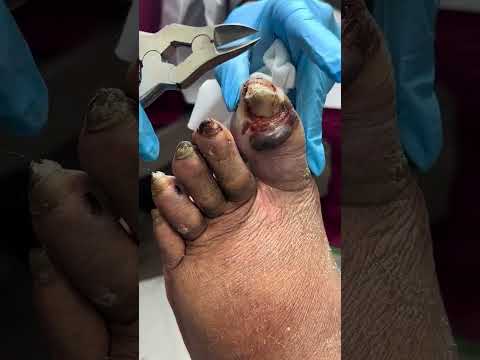 هكذا نعالج فطريات أظافر القدم لدى مرضى السكري