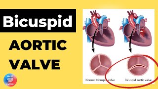 Bicuspid Aortic Heart Valve