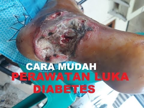 Video: Gangren Kaki Dengan Diabetes Mellitus - Gejala Dan Rawatan