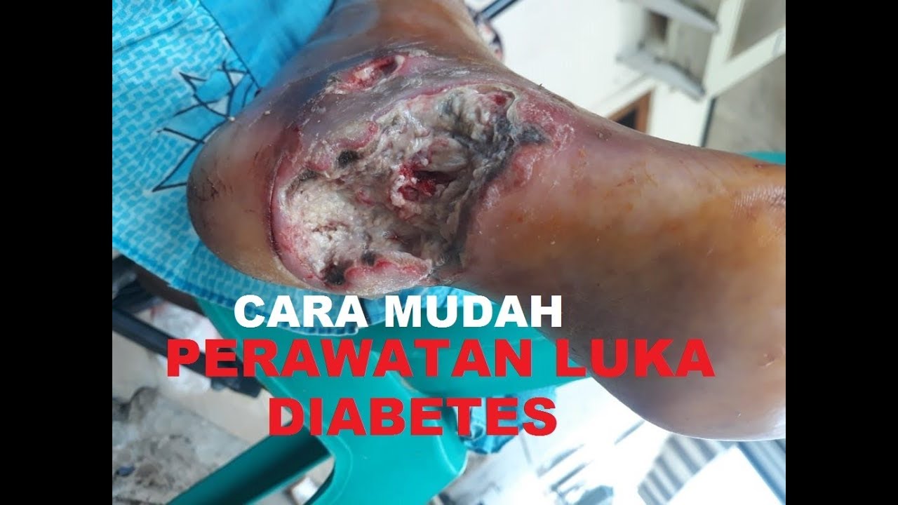 Cara Mengobati Luka Diabetes, perawatan luka dapat kita lakukan sendiri
