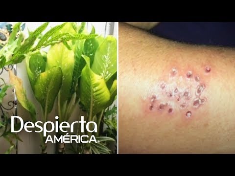 Video: Alergia A Las Plantas: ¿cómo Tratarla?