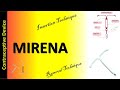 Mirena   levonorgestrel releasing intrauterine system  mirena insertion and removal technique