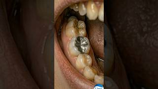 Amalgam Restoration: Step-by-Step Tooth Repair Transformation #toothfilling #amalgam