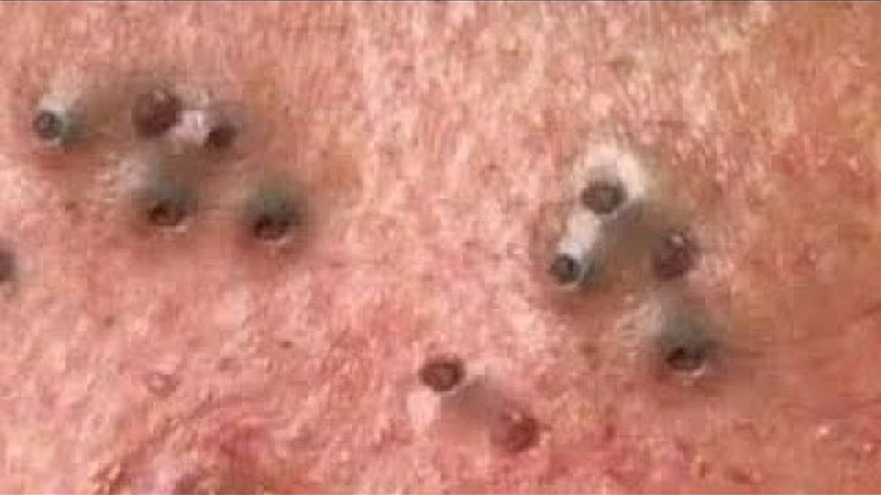 big-cystic-acne-blackheads-extraction-blackheads-milia-whiteheads