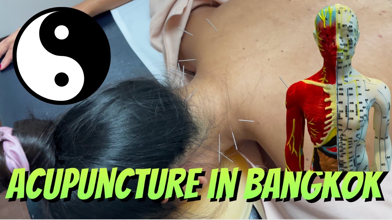 ACUPUNCTURE in Bangkok! (Does it Hurt? Does it Really Work?)