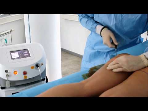 Video: Laserska Liposukcija - Lasersko Odstranjevanje Maščobe Za Blast Maščobe