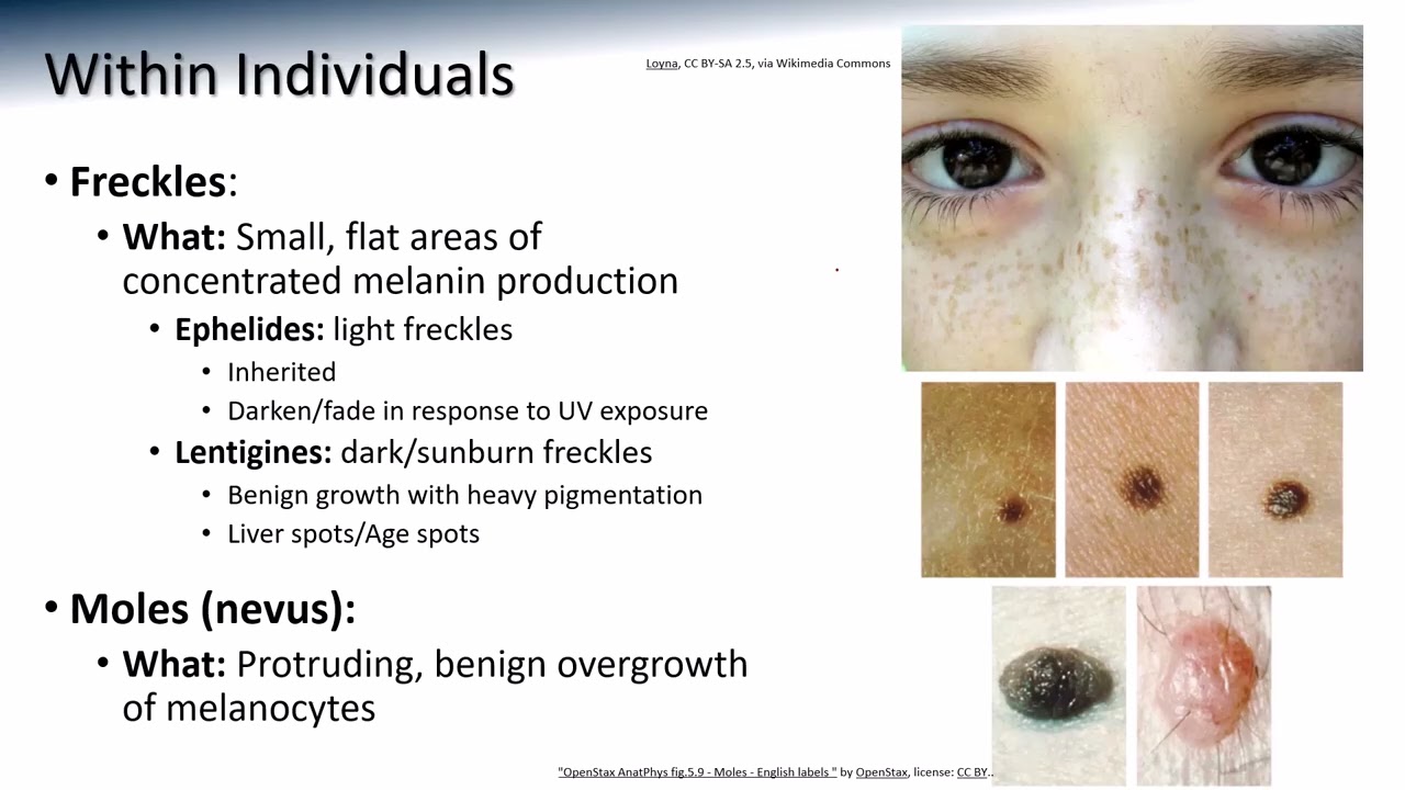melenic or melanotic Integument 6: Melanin