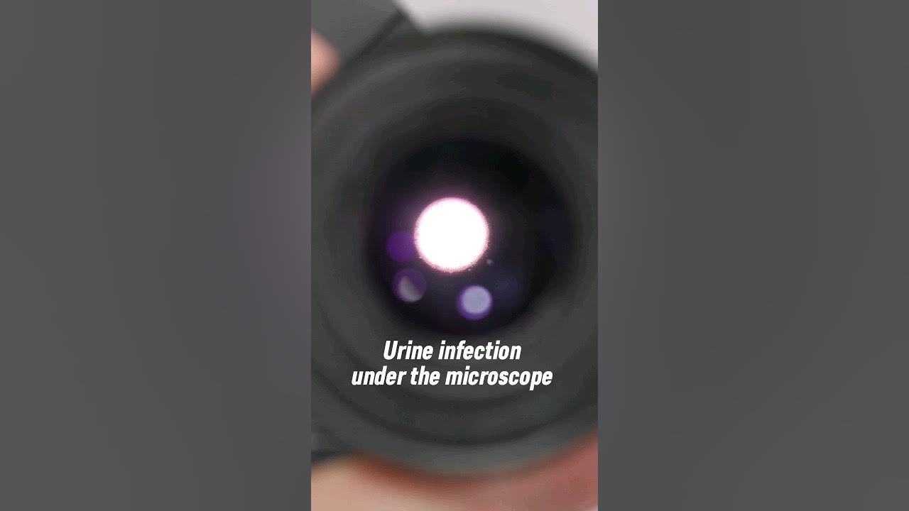 white blood cells in urine under the MICROSCOPE SCANNING OBJECTIVE LPO