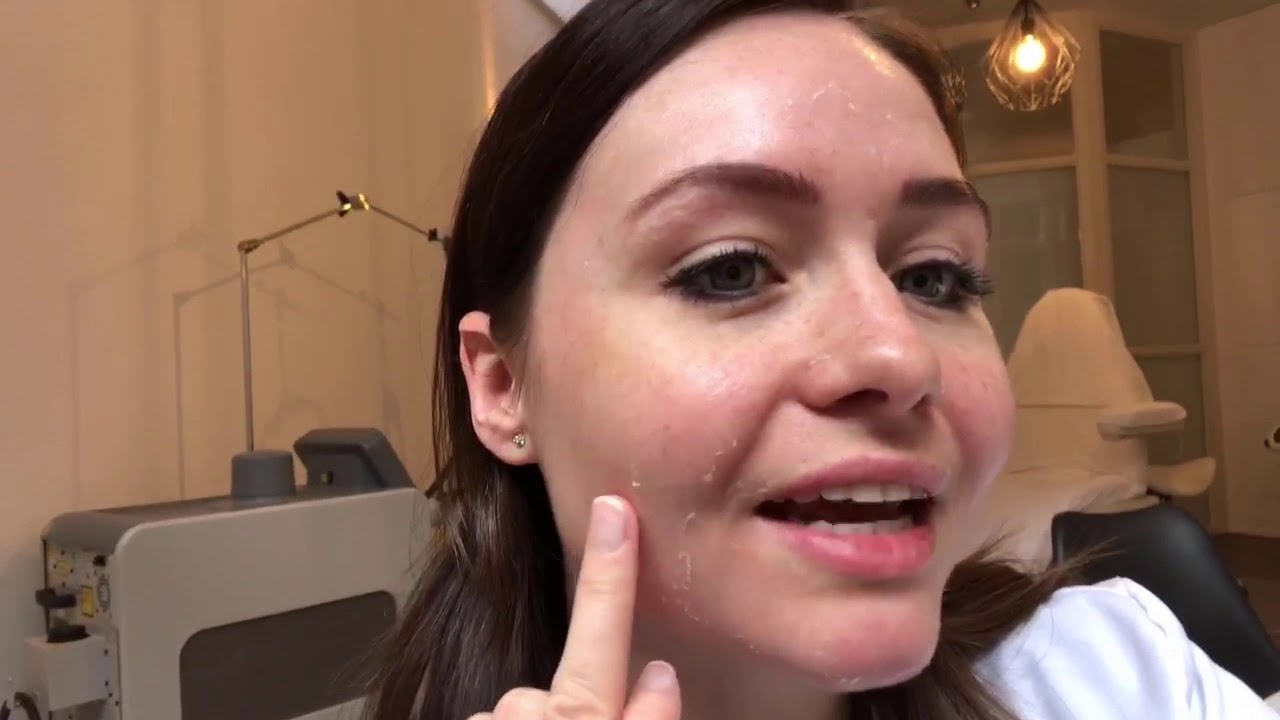 TCA peeling (voor en na)