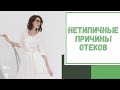 Лайфхак №96. Нетипичные причины отеков