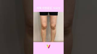 하체지방흡입 맛집, 리얼 후기_1 #지방흡입 #지방흡입후기