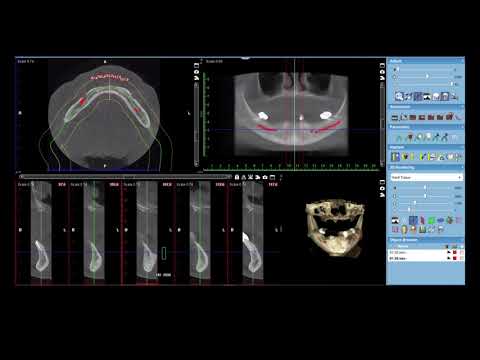 Treatment Planning Implants