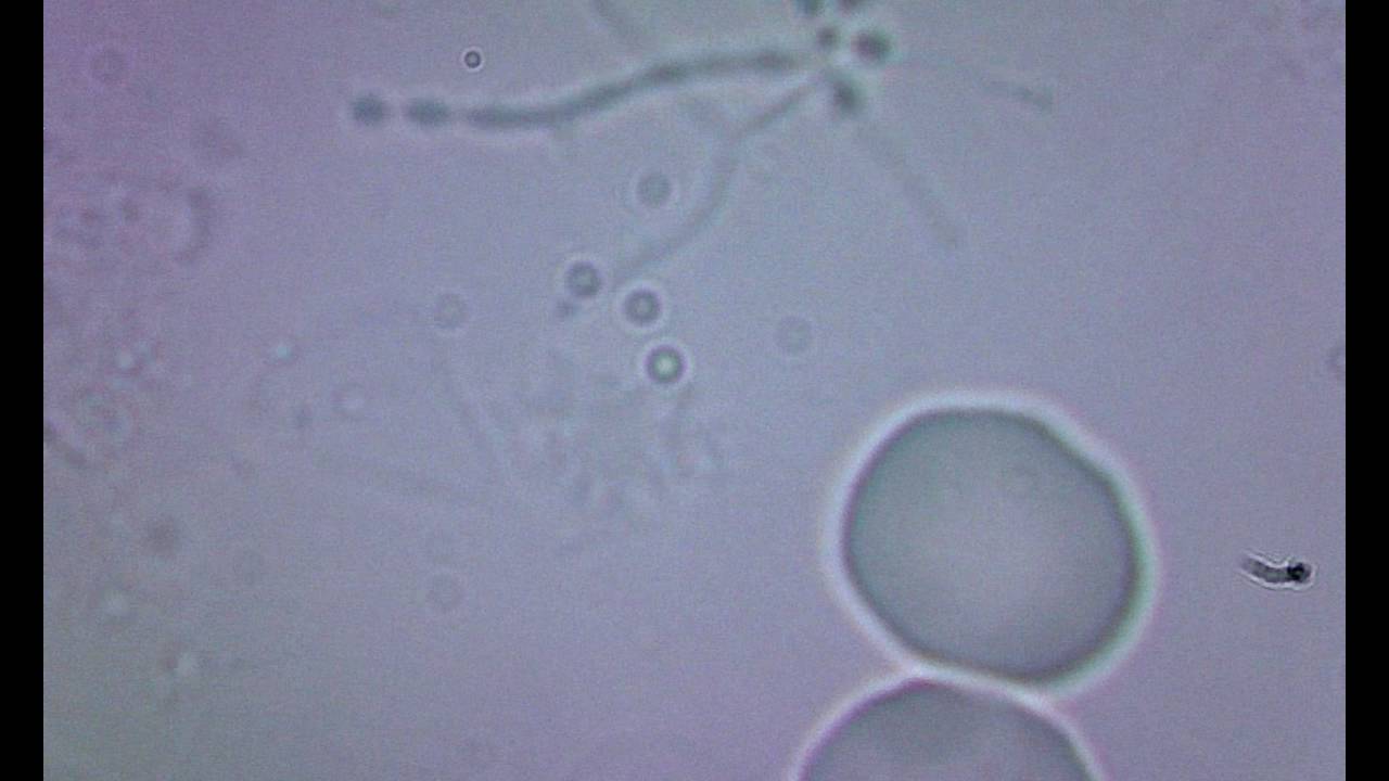 Lyme under the microscope 5 YouTube