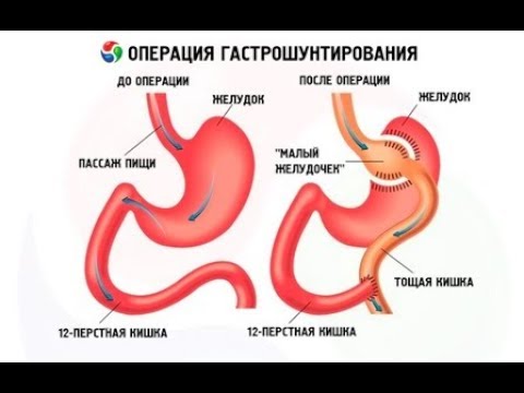 Сколько стоит шунтирование желудка в москве цена и отзывы