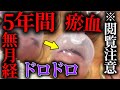 【閲覧注意　生理　鍼治療】瘀血ドロリ　5年半無月経・生理不順には鍼治療がおすすめ　メンテ成功　【横浜元町　銀座日本橋　鍼灸院】