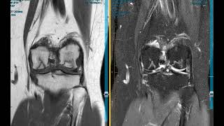 Unexplained knee pain in 40 year old female
