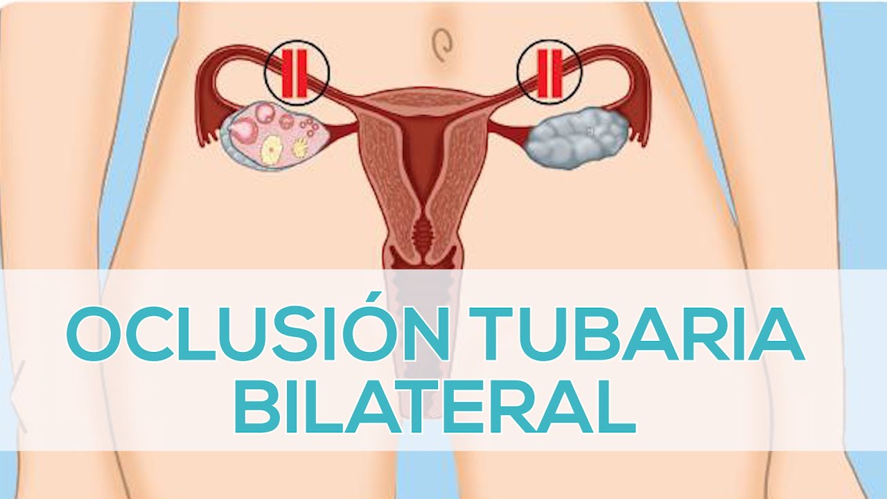 OCLUSIÓN TUBARIA BILATERAL | Fertyplace - YouTube