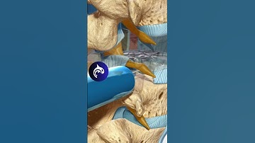 See how a Transforaminal Lumbar Interbody Fusion (TLIF) of the Spine works #3D #backpain #stem