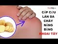 CẤP CỨU LÀN DA cháy sạm vì nắng nóng chỉ bằng 1 CỦ KHOAI TÂY