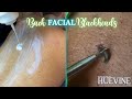 The back facial with a blackened cyst  treat your bacne part 1  huevine