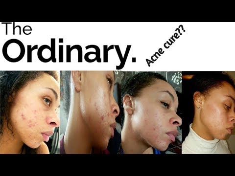 The Ordinary review| clearing up cystic acne