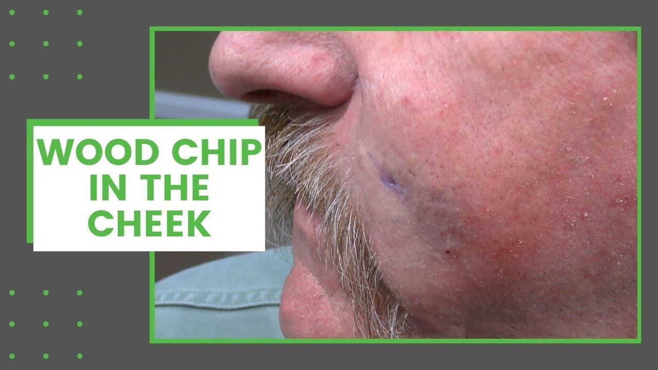 Wood Chip in the Cheek | Dr. Derm - YouTube