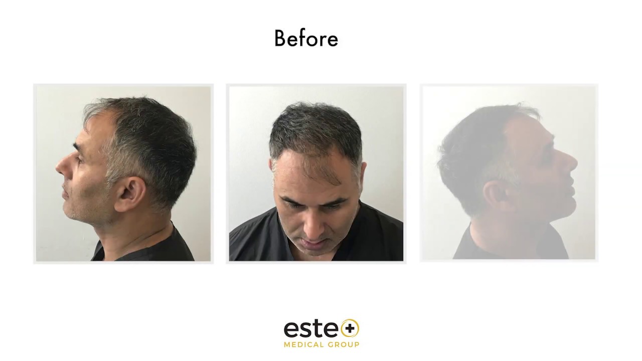 FUE Hair Transplant and Aftercare journey Este Medical Group YouTube