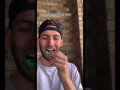 Video: Werk opalescence tande bleik?