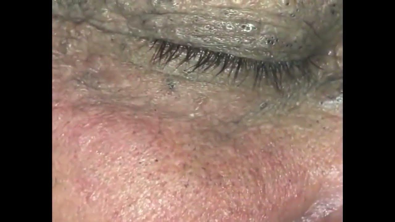 Pimple, Popping, Removing Blackheads around eyes Bigger Blackhead , on the face, acne YouTube