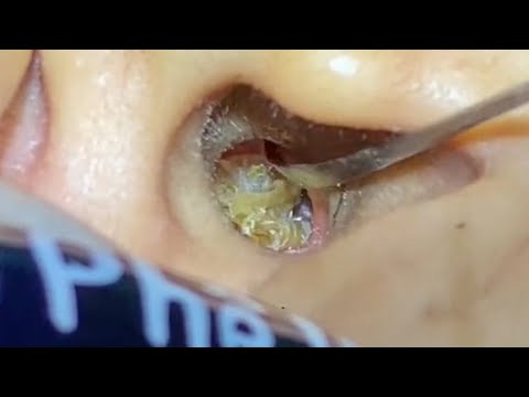 ASMR Ear Cleaning – The Surprising Health Benefits of Proper Ear Care