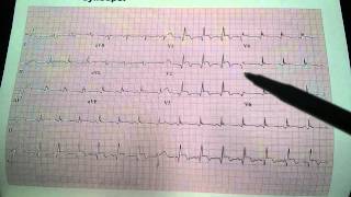 76 femal chest pain syncope ekg ecg electrocardiogram uri m. ben-zur md facc