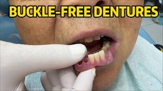 Watch a Flexible Partial being born from scratch 😍🦷#InvisibleDenture #FlexiblePartial #DentureMaking