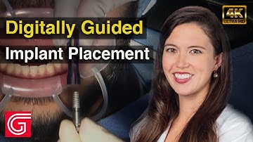 Digitally Guided #ImplantPlacement