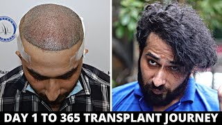 FUE Hair Transplant Timeline I Day 1 to Day 365 I Before & After | Born Creator