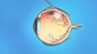 Retinal Tear Cryopexy