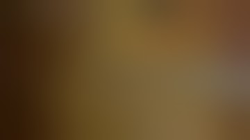 HD Laparoscopic subtotal D2-gastrectomy