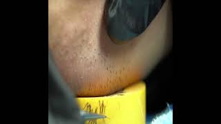 Extractions Unwanted under rip Hair on the tape l Tweezers Beard l 2021/7/11 for mobile