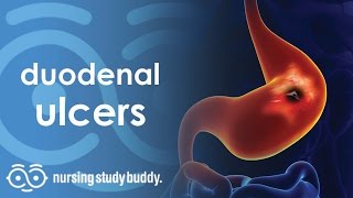 Nursing Care: Duodenal Ulcers (Part 1) - Nursing Study Buddy Video Library