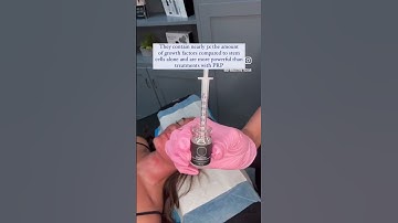 Exosomes with Microneedling