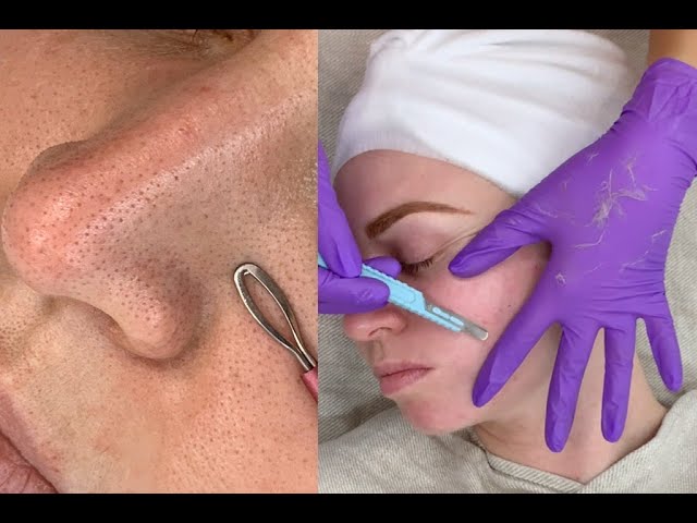 Dull Skin + Stubborn Blackheads & Dermaplaning Facial | Jadeywadey180