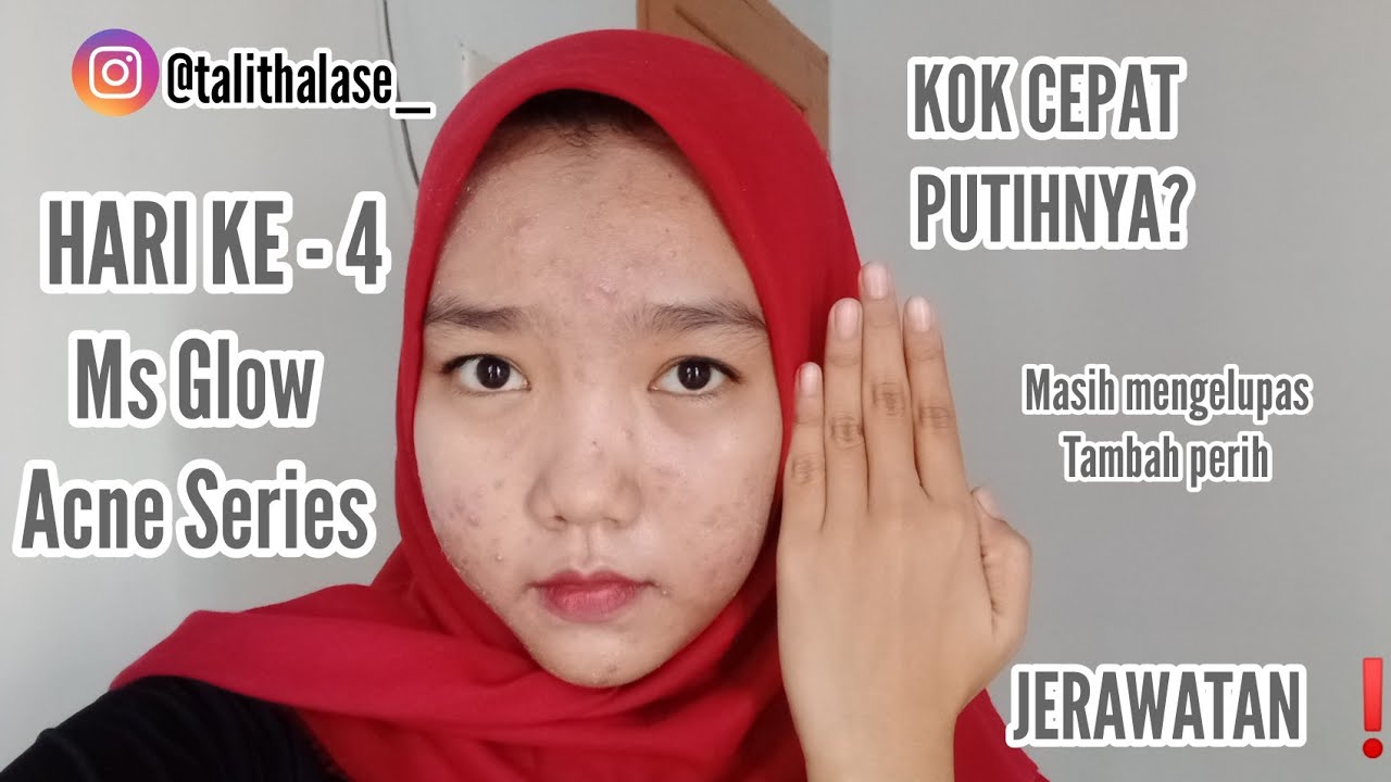 REVIEW MS GLOW ACNE SERIES | HARI KE-4 | DAY CREAM NYA
