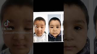 Чап кўз юқори қовоқ птозини тўғирлаш операциясидан кейинги натижамиз. #птоз