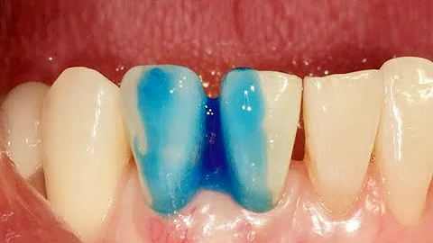 Aesthetic restoration in anterior zone with Bright...