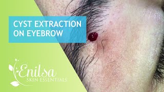 Cyst Extraction on Eyebrow
