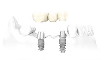 Single missing tooth replacement options
