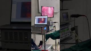 TLH surgery
