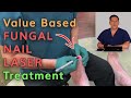 Value Based Fungal Nail Laser Treatment by Dr. Michael Horwitz